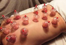 Falsi miti. Coppettazione: la moda dei succhiotti che non serve a niente!