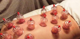 Falsi miti. Coppettazione: la moda dei succhiotti che non serve a niente!